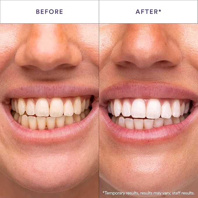 Purple Teeth Whitening Strips – 14 Treatments - Viral Drop Club